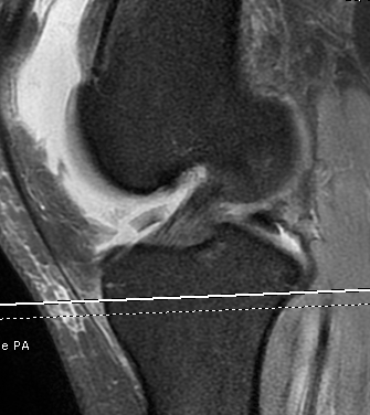 Patella Dislocation MRI Loose Body Notch